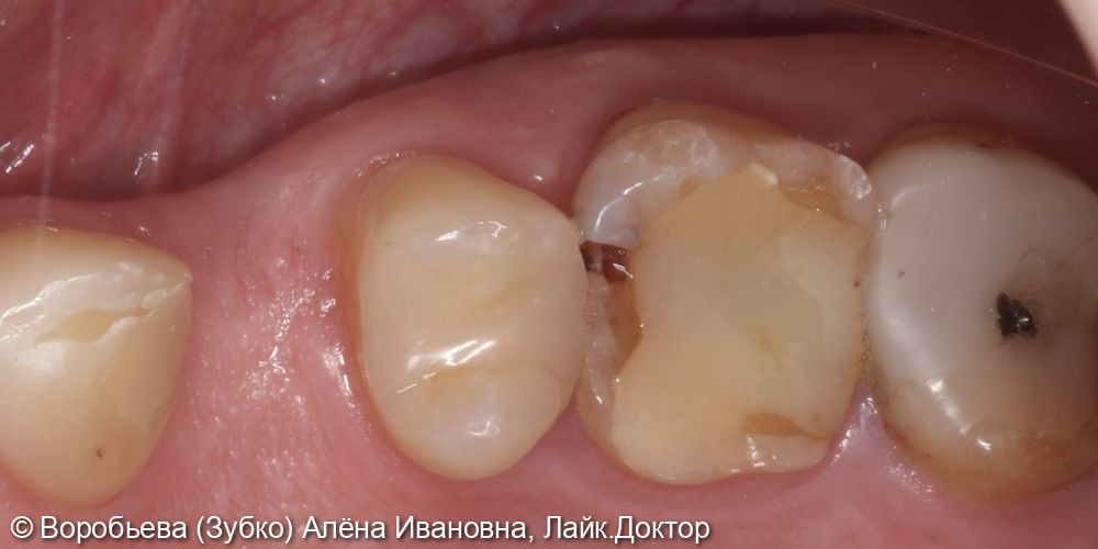 Лечение хронического периодонтита 16 зуба - фото №1