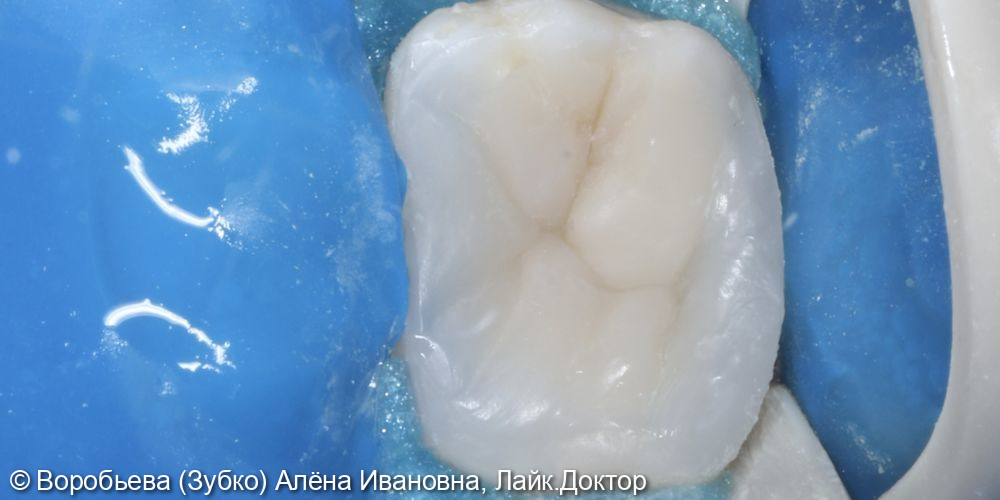 Лечение хронического периодонтита 16 зуба - фото №6