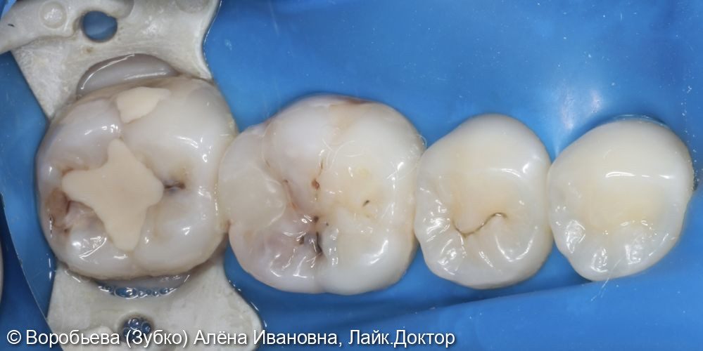 Лечение глубокого кариеса 36 и 37 го зуба - фото №1