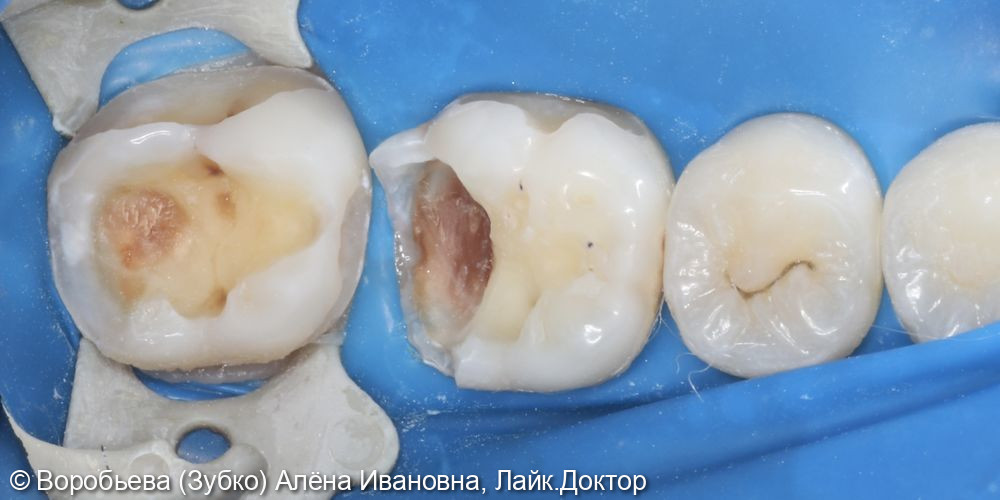 Лечение глубокого кариеса 36 и 37 го зуба - фото №2