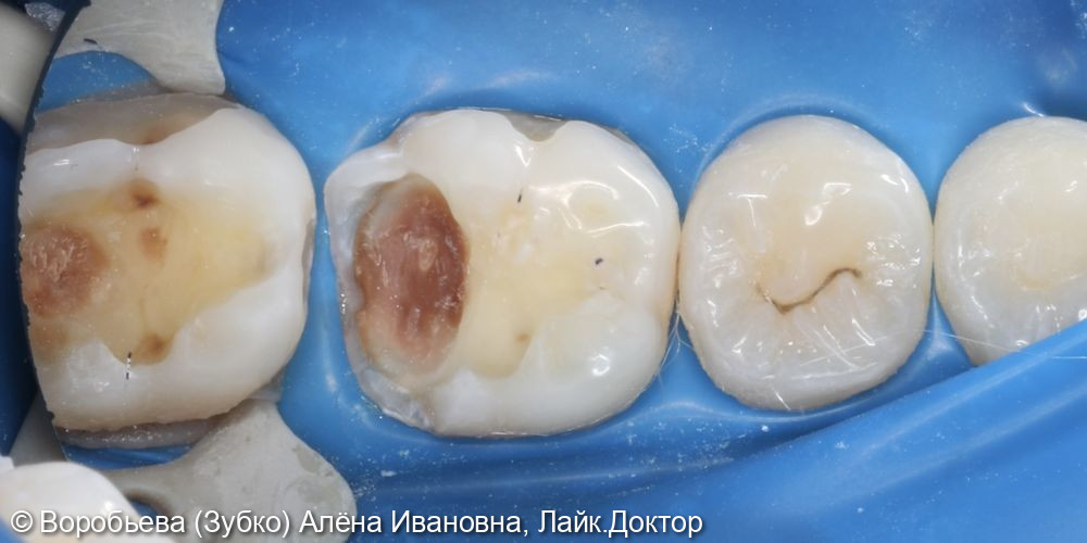 Лечение глубокого кариеса 36 и 37 го зуба - фото №3