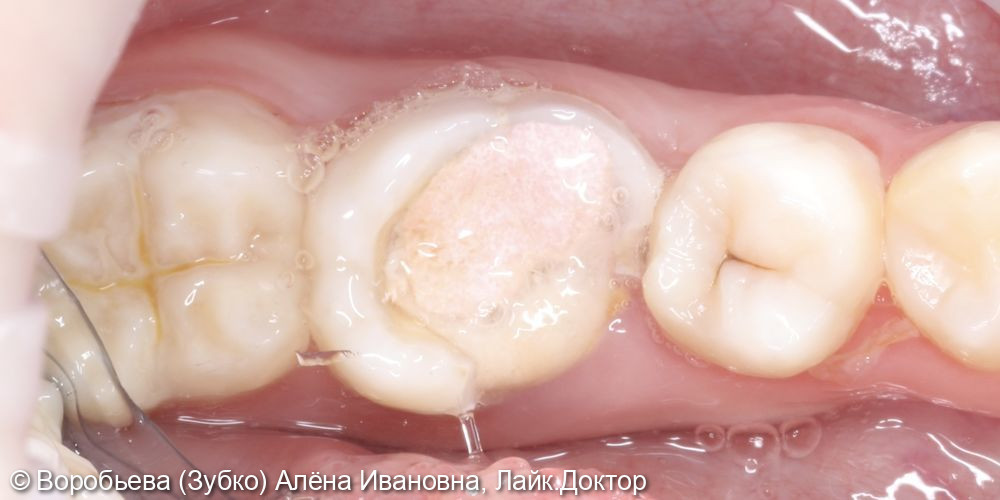 Лечение хронического периодонтита 46 зуба - фото №1
