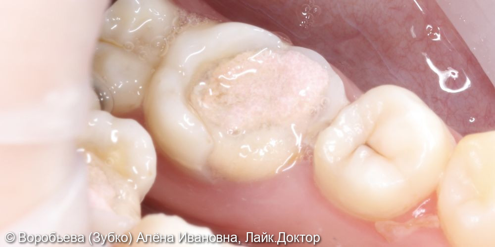 Лечение хронического периодонтита 46 зуба - фото №2