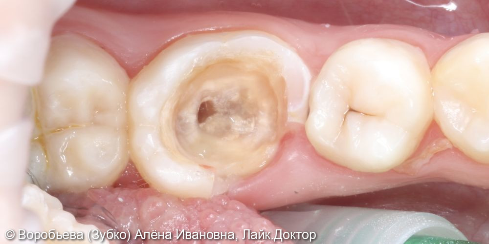 Лечение хронического периодонтита 46 зуба - фото №3