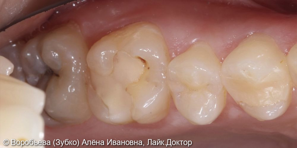 Лечение кариеса 2.5, 2.6 и 2.7 Зубов - фото №1