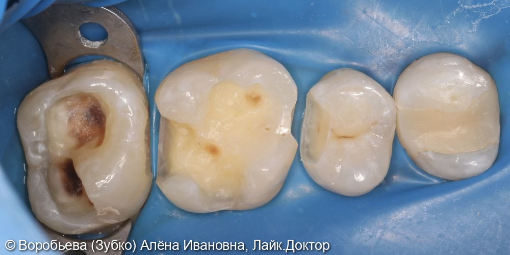 Лечение кариеса 2.5, 2.6 и 2.7 Зубов - фото №2