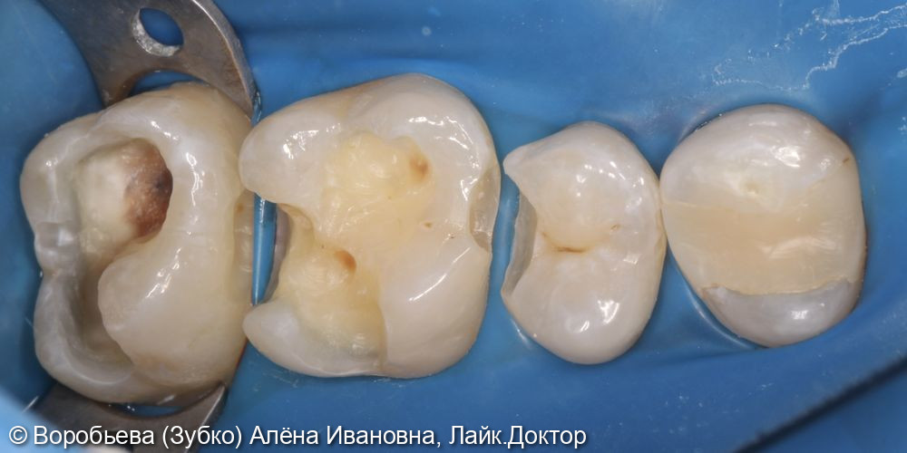 Лечение кариеса 2.5, 2.6 и 2.7 Зубов - фото №3