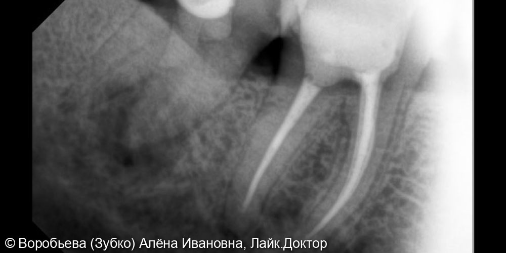 Лечение хронического апикального периодонтита 38 зуба - фото №1