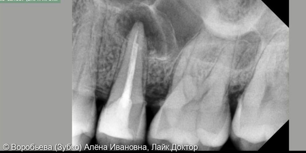 Лечение апикального периодонтита 2.5 го зуба - фото №1