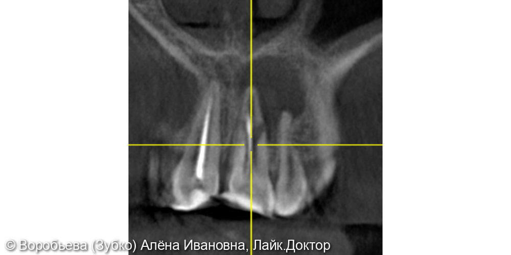 Уникальный случай лечения периодонтита передних Зубов - фото №3