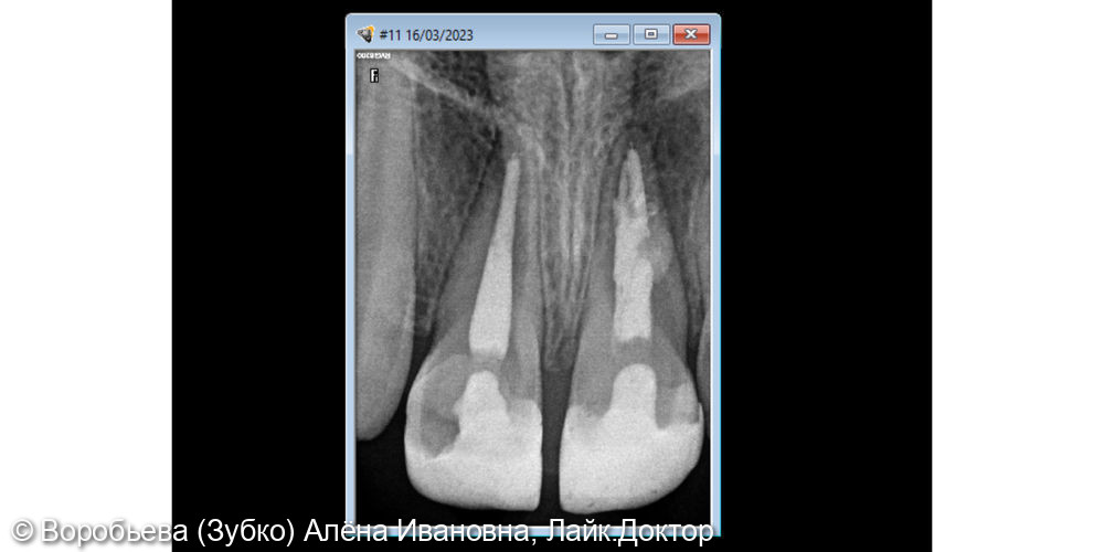 Уникальный случай лечения периодонтита передних Зубов - фото №6