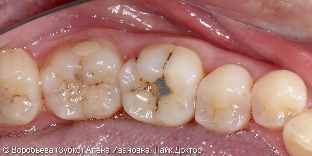 Лечение кариеса 3.7, 3.6 и 3.5 зубов - фото №1