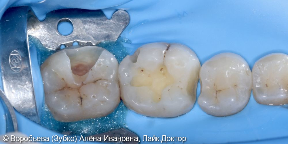 Лечение кариеса 3.7, 3.6 и 3.5 зубов - фото №2