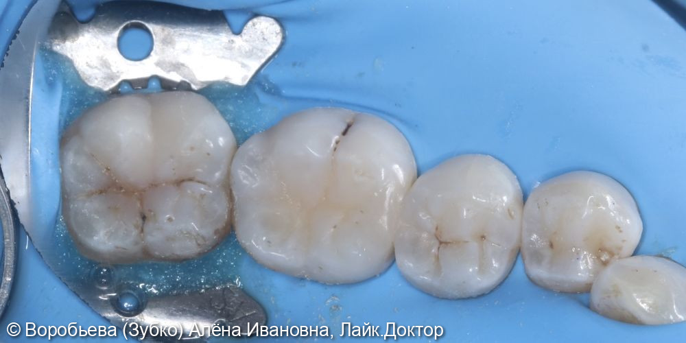 Лечение кариеса 3.7, 3.6 и 3.5 зубов - фото №3