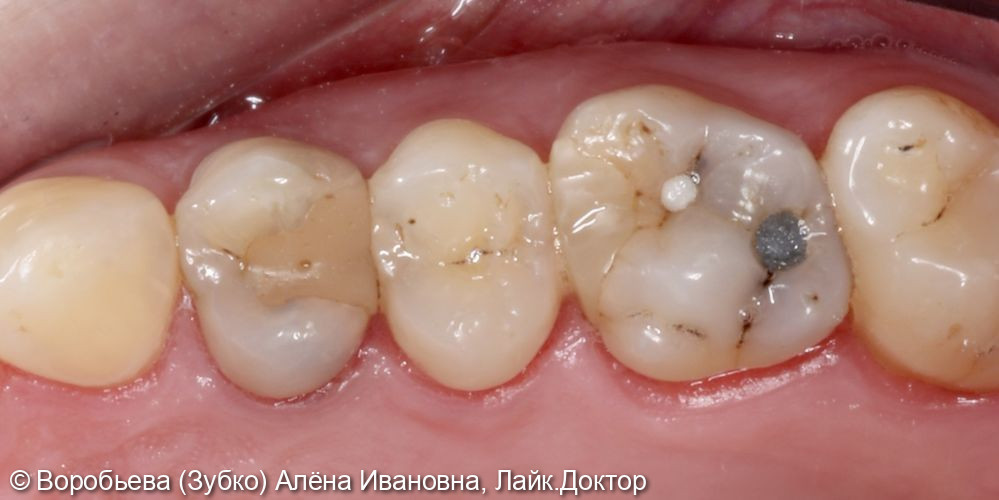 Лечение кариеса 1.6, 1.5 и 1.4 зубов - фото №1