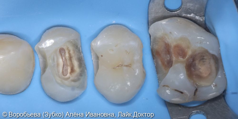 Лечение кариеса 1.6, 1.5 и 1.4 зубов - фото №2