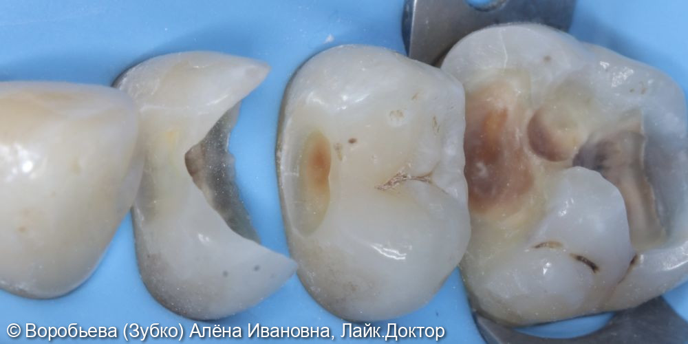 Лечение кариеса 1.6, 1.5 и 1.4 зубов - фото №3