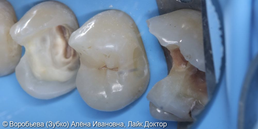 Лечение кариеса 1.6, 1.5 и 1.4 зубов - фото №4