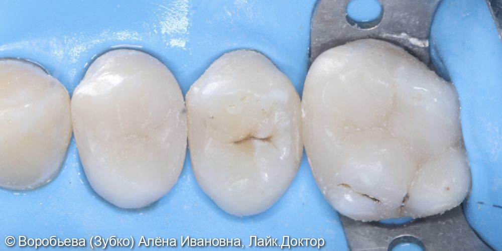 Лечение кариеса 1.6, 1.5 и 1.4 зубов - фото №5
