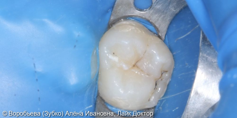 Лечение скрытого кариеса 16 зуба - фото №1