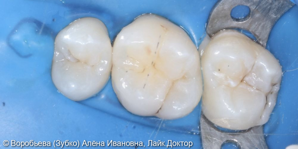 Лечение скрытого кариеса 16 зуба - фото №2