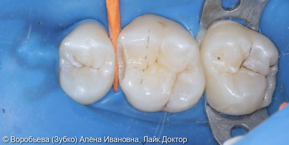 Лечение скрытого кариеса 16 зуба - фото №3
