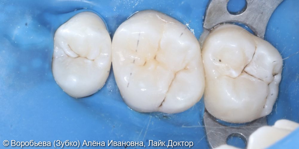 Лечение скрытого кариеса 16 зуба - фото №4