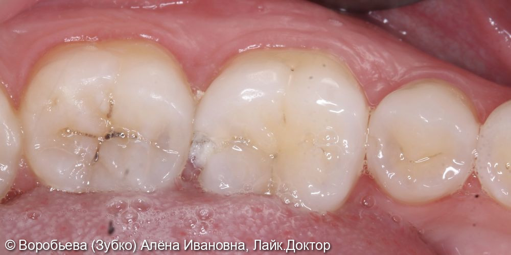 Лечение кариеса 36 и 37 зуба - фото №1