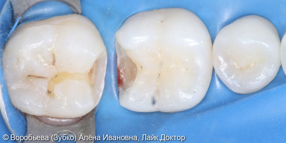 Лечение кариеса 36 и 37 зуба - фото №3