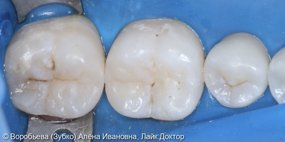 Лечение кариеса 36 и 37 зуба - фото №4