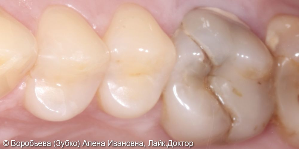 Попытка лечения 16 зуба - фото №1