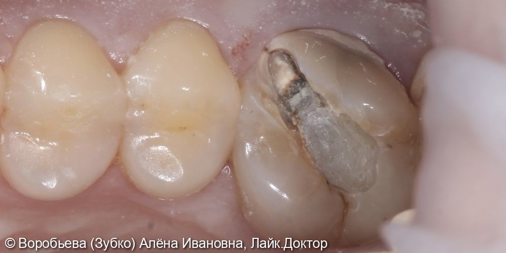 Попытка лечения 16 зуба - фото №2