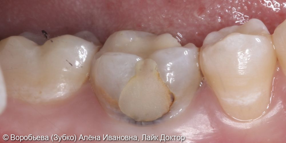 Лечение 36 зуба - фото №1