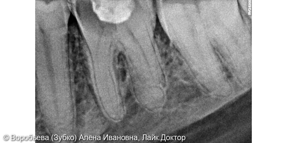 Лечение 36 зуба - фото №3