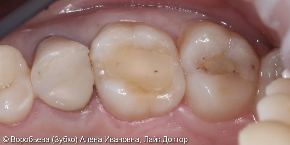 Лечение кариеса 16 и 17 зуба - фото №1