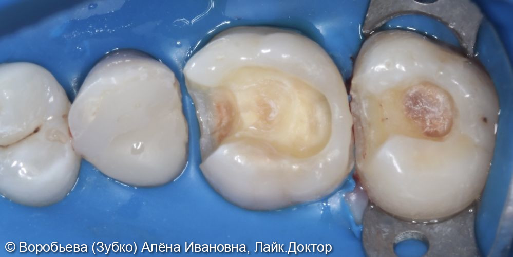 Лечение кариеса 16 и 17 зуба - фото №2