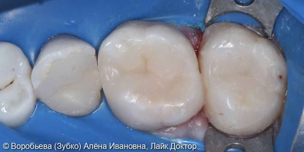 Лечение кариеса 16 и 17 зуба - фото №3
