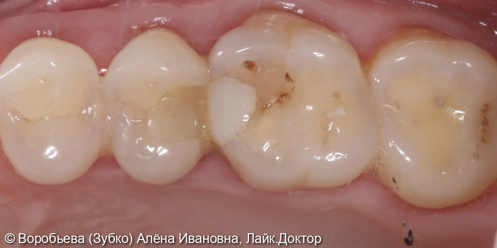 Лечение глубокого кариеса 16 зуба - фото №1