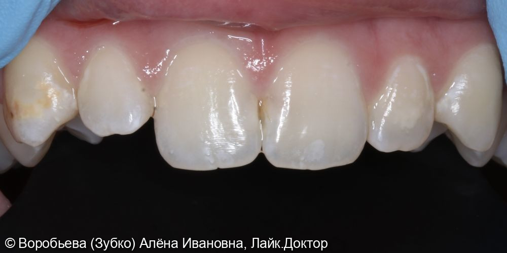 Лечение кариеса 11 и 21 зуба - фото №1