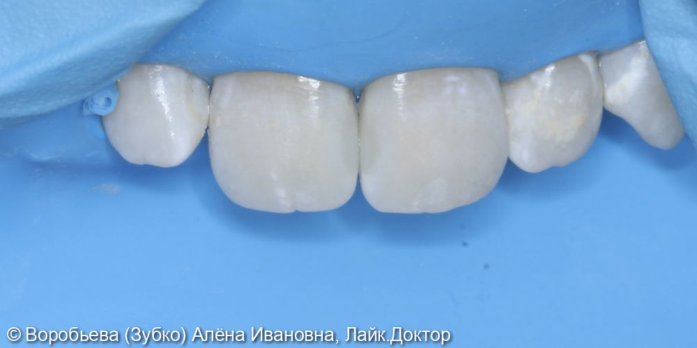 Лечение кариеса 11 и 21 зуба - фото №3