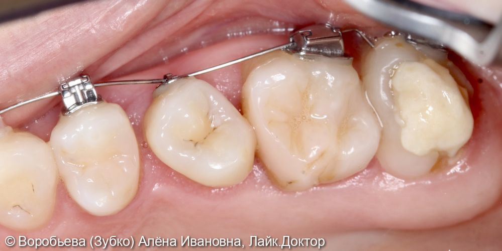 Лечение кариеса 14,15,17 го и пульпита 16 зубов - фото №9