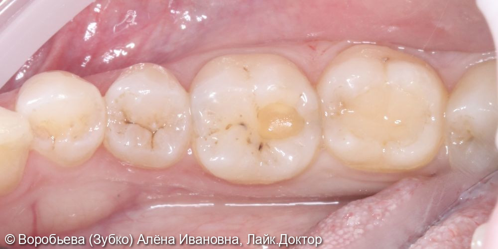 Лечение кариеса 37 и 36 зубов - фото №1