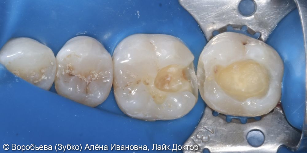 Лечение кариеса 37 и 36 зубов - фото №2