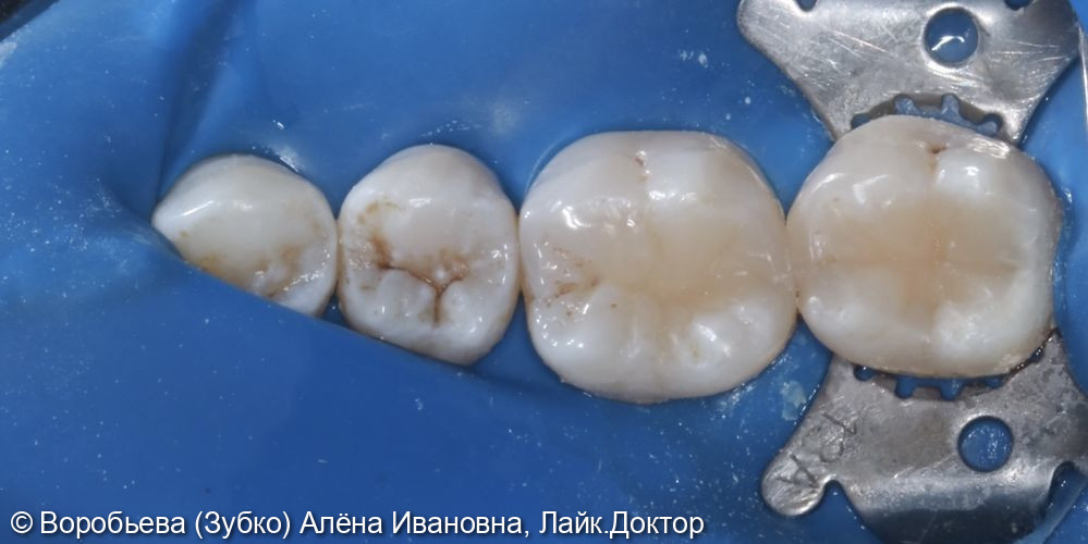Лечение кариеса 37 и 36 зубов - фото №3