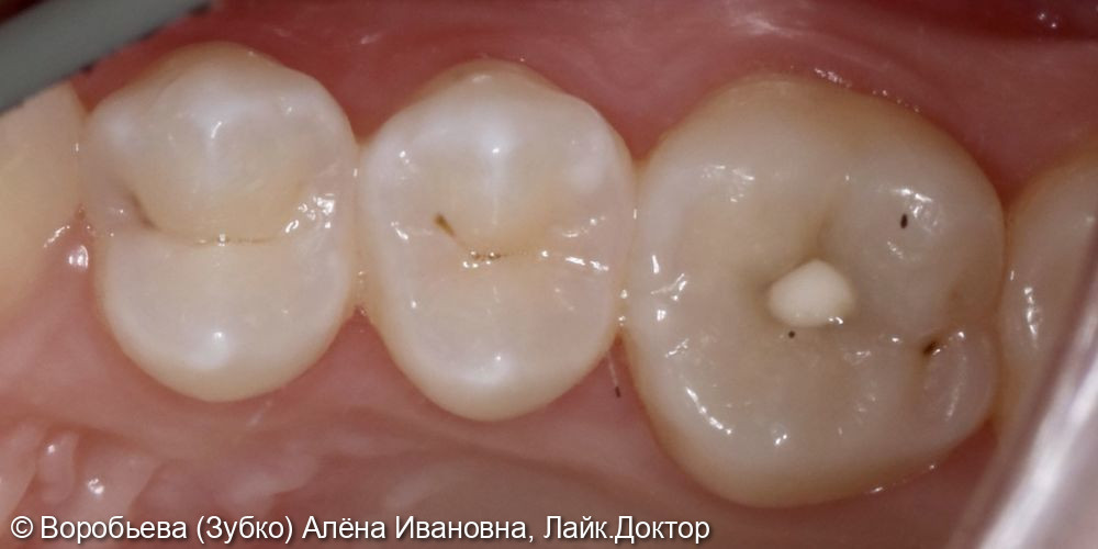 Лечение кариеса 14 и 16 зуба - фото №1