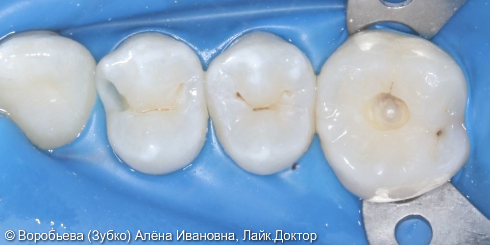 Лечение кариеса 14 и 16 зуба - фото №2