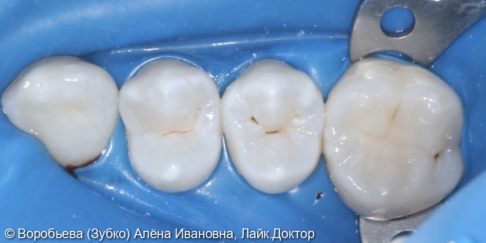Лечение кариеса 14 и 16 зуба - фото №3