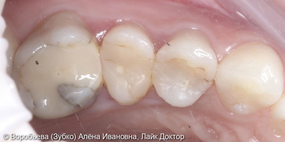 Подготовка Зубов к протезированию - фото №1