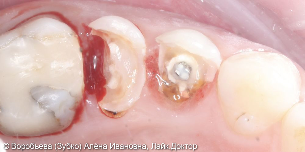 Подготовка Зубов к протезированию - фото №2