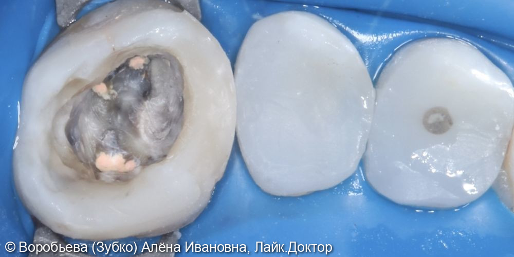 Подготовка Зубов к протезированию - фото №4